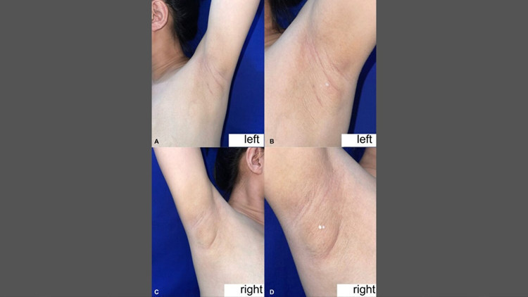 filipinli kadinin koltukaltindan sut geldi nadir gorulen durumun nedeni ne keSN5MvH.jpg